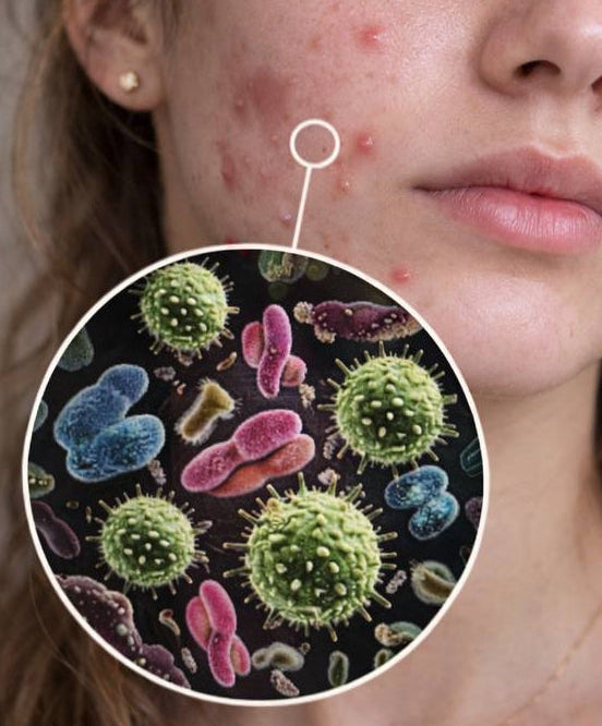 Woman with acne on her face, with a magnified inset showing acne-causing bacteria.
